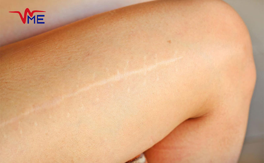 Advanced Scar Treatments for Smoother Skin