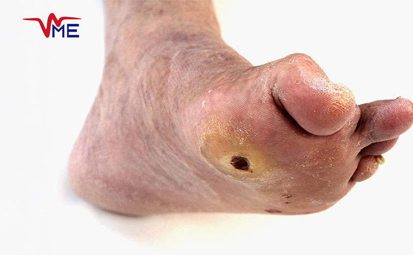 Effective Management of Diabetic Foot Ulcers (1)