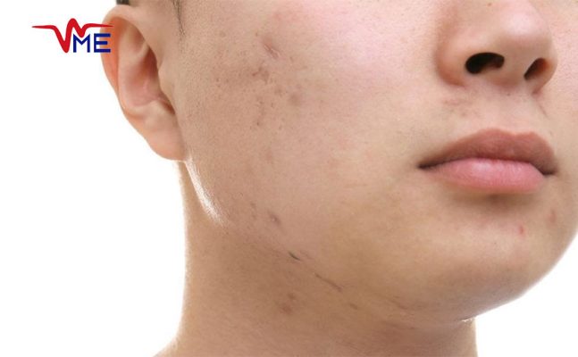 Advancements in Laser-Assisted Scar Removal for Smooth Skin