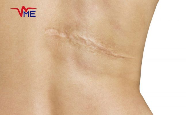 Advancements in Laser-Assisted Scar Removal for Smooth Skin